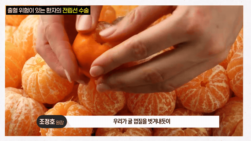 Doctor using dynamic hand gestures to illustrate peeling the prostate like a tangerine